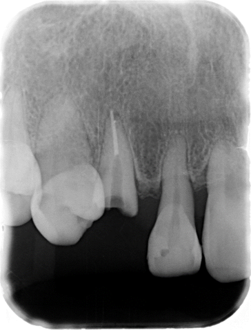 抜歯と診断された歯を救う治療