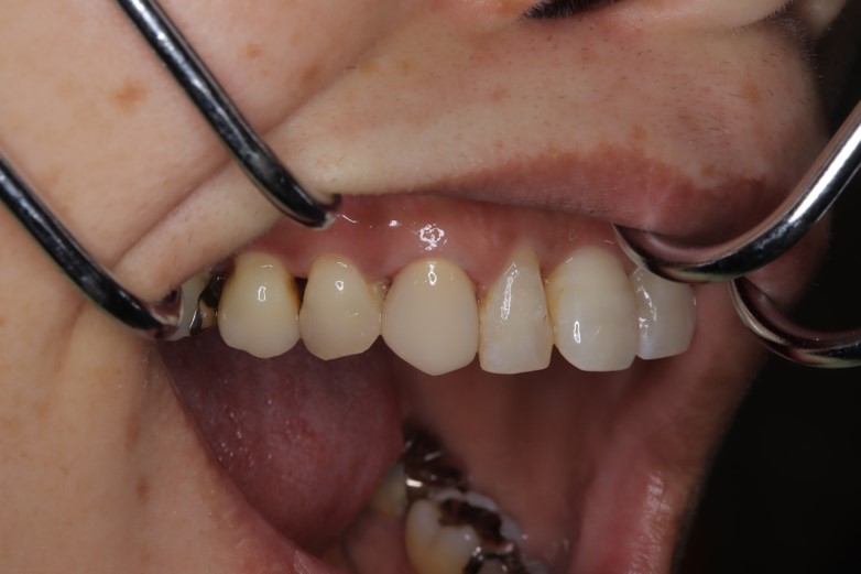 抜歯と診断された歯を救う治療