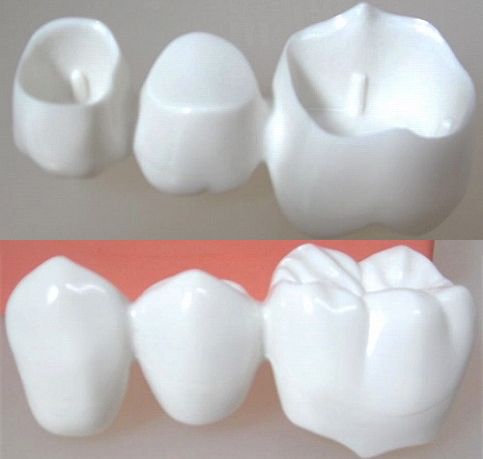 従来の無くなった歯を入れる治療法（ブリッジ）