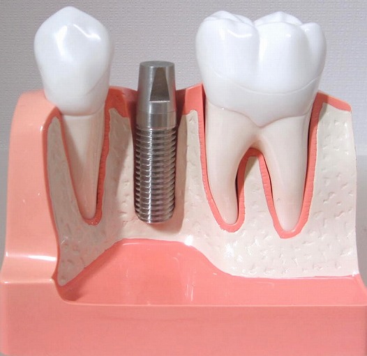 インプラントによる無くなった歯を入れる治療法