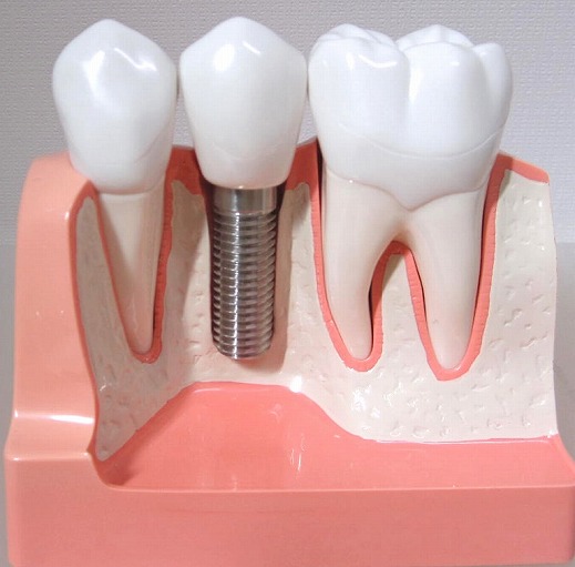 インプラントによる無くなった歯を入れる治療法