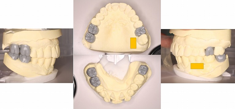 ①まず最終的にどのような歯を入れるのかを模型上やレントゲン、CT等で計画を行い、それに従って、インプラントを入れる位置を決めます。