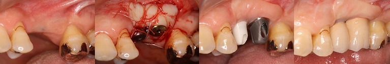 インプラント症例②　歯ぐきの移植を併用したケース