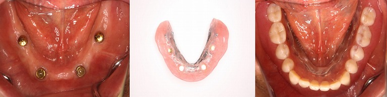 インプラント症例③　総入れ歯の安定を目的に行ったケース