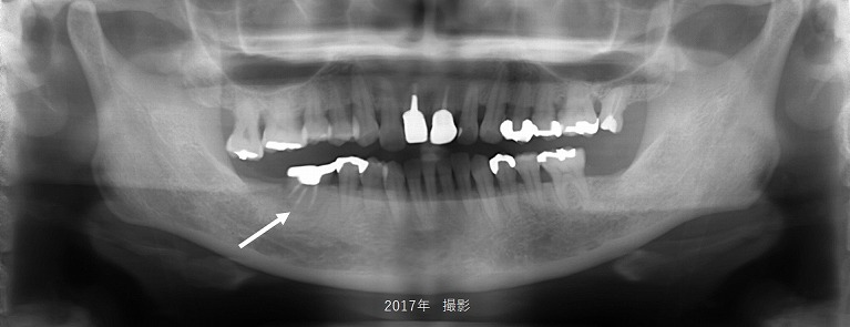 症例②